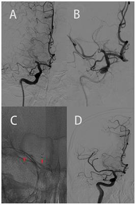 Rescue stenting after the failure of mechanical thrombectomy to treat acute intracranial atherosclerotic occlusion